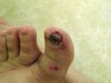 nastytoe.jpg